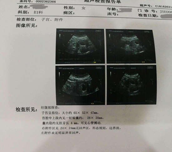  年纪轻轻，我用供卵怀上宝宝一路心酸